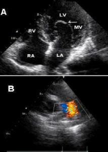 Abnormal mitral valve with congenital elongation and patent ductus arteriosus was shown apical four chamber view (A) and parasternal short axe view (B) Abnormal mitral valve with congenital elongation and patent ductus arteriosus was shown apical four chamber view (A) and parasternal short axe view (B)
