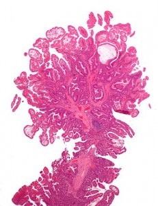 Peutz Jeghers syndrome polyp