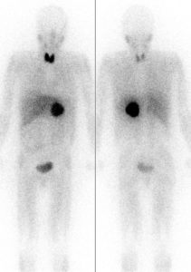 Pheochromocytoma