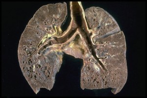 Photograph of a Lung with Sarcoidosis