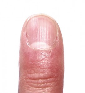 Pitting his fingernails in psoriasis