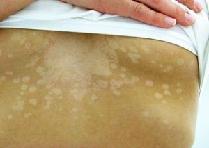 Pityriasis versicolor