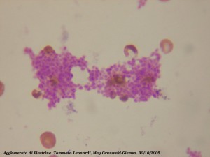 Platelets clumping from a blood smear. May Grunwald-Giemsa. Light Microscopy, oil immersion 100x.