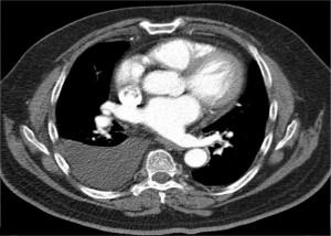 Pleural_effusion_CT_axial