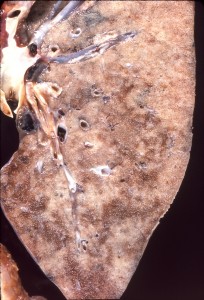 Pneumocystis jiroveci infection