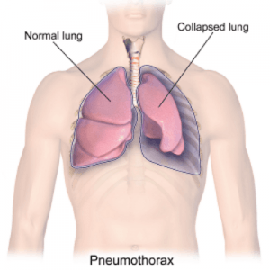 Pneumothorax