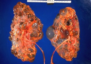 Polycystic kidneys gross pathology