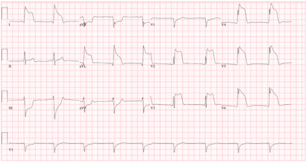 Prinzmetal angina