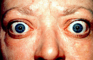 Proptosis-and-lid-retraction-from-Graves'-Disease