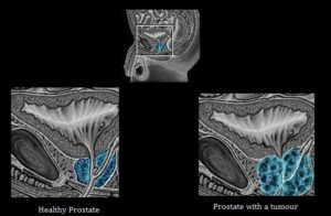 prostate cancer