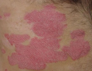Psoriasis plaque . In higher resolution the silvery whitish remnants of the fallen skin layer are visible