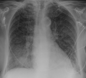 Pulmonary edema Pulmonary edema