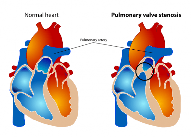 Pulmonary valve stenosis Pulmonary valve stenosis