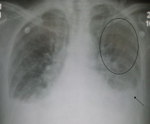 Pulmonaryedema