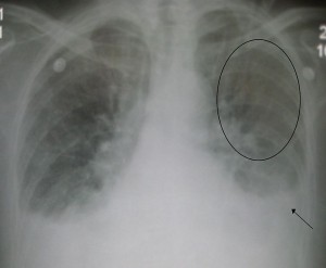 PulmonaryedemaBig