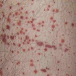 Purpura Purpura