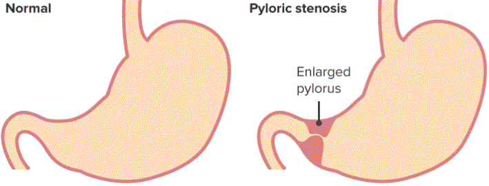 Infantile Hypertrophic Pyloric Stenosis (IHPS): Causes & Symptoms