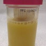 Pyuria in a person with urosepsis Pyuria in a person with urosepsis