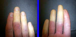 Raynauds’ Disease