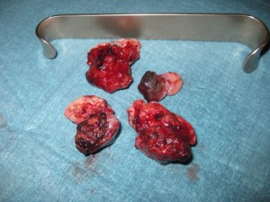 Resected hemorrhoid cushion after hemorrhoid surgery