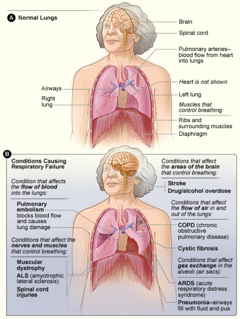 Respiratorisk svikt