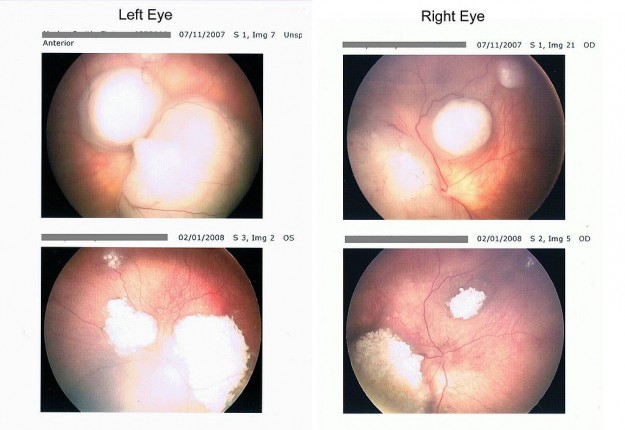 Retinoscan before and during chemotherapy Retinoscan before and during chemotherapy