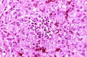 Reyes syndrome liver-histology