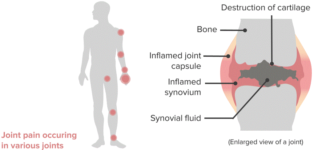 Rheumatoid Arthritis (RA, Atrophic Arthritis) and Still's Disease ...