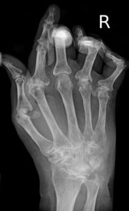 RheumatoideArthritisAP