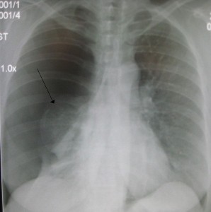 Rt_sided_pneumoDWP