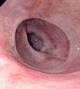 schatzki ring endoscopy