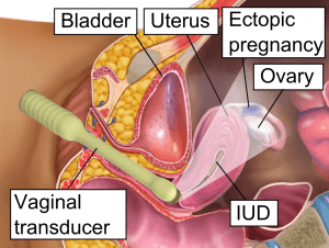 Schematic figure of vaginal ultrasound in ectopic pregnancy
