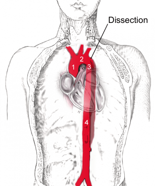 Scheme of aortic dissection Scheme of aortic dissection