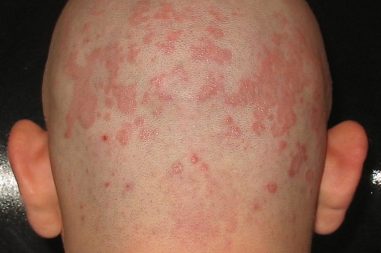 eczema on head scalp treatment