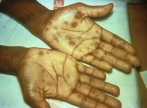 secondary syphilis – palmar rash