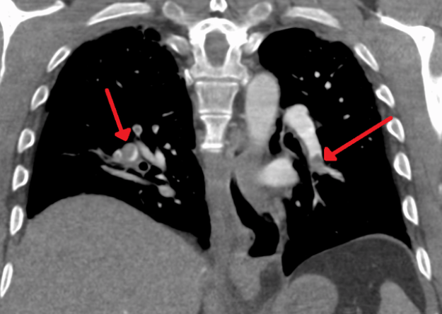 Segmental and subsegmental pulmonary emoboli on both sides