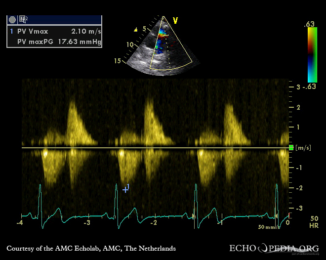 Severe pulmonary regurgitation Severe pulmonary regurgitation