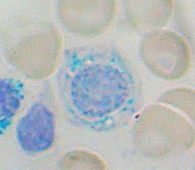 Sideroblast, as seen in sideroblastic anemia