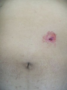Single gunshot wound Single gunshot wound