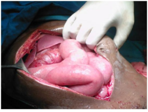 Small bowel injury in peritoneal encapsulation following penetrating abdominal trauma