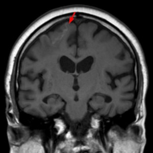 Some day old cortical infarction right up front with low hemorrhage