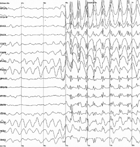 An electroencephalogram of a person with childhood absence epilepsy showing a seizure.