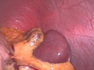 Laparoscopic view of a human spleen.