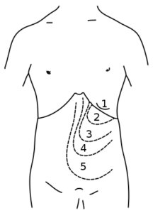 Splenomegaly in different grades