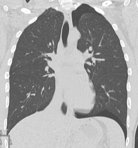Spontaneous pneumothorax-CT-young-man
