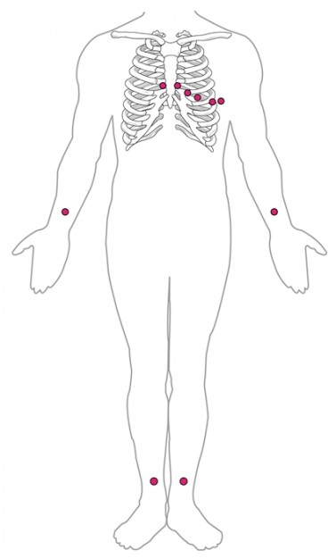 Standard Placement of ECG Leads