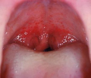 Streptococcal pharyngitis