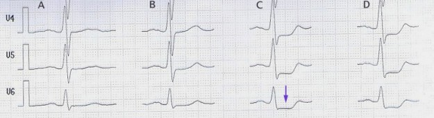 Stress ECG ST Depression