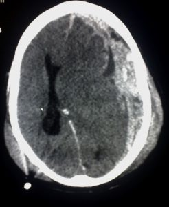 Subdurale bloeding