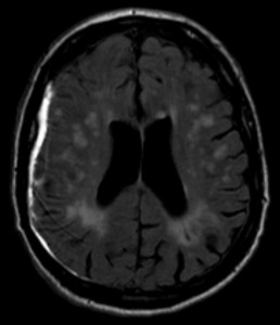 Subdural-hematoma-MRT